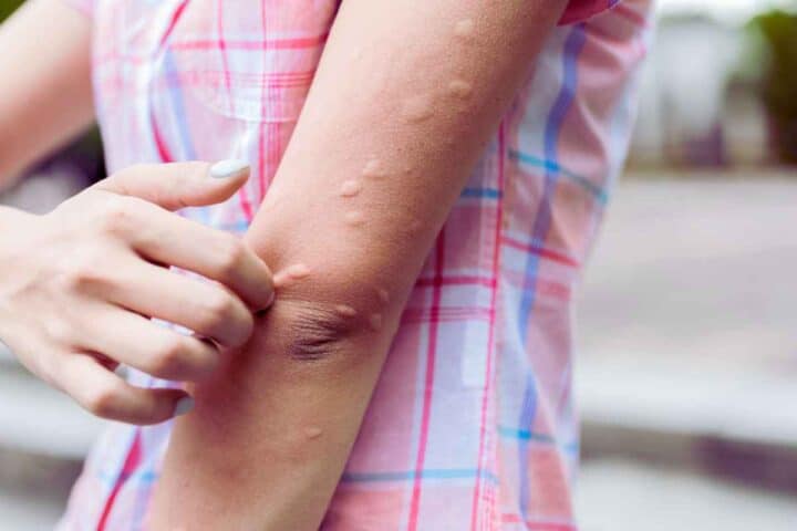 Addio alle zanzare e al prurito: la soluzione oggi è tech